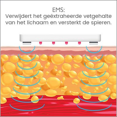 Silk'n lipo 2 - EMS: verwijderd vetgehalte en versterkt de spieren