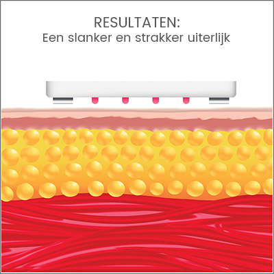 Silk'n lipo 3 - Resultaten: Een slanker en strakker uiterlijk Silk'n lipo 3 - Resultaten: Een slanker en strakker uiterlijk