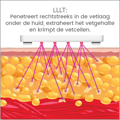 Silk'n lipo 1 - LLT: rechtstreeks in de huid en krimpt zo de vetcellen Silk'n lipo 1 - LLT: rechtstreeks in de huid en krimpt zo de vetcellen